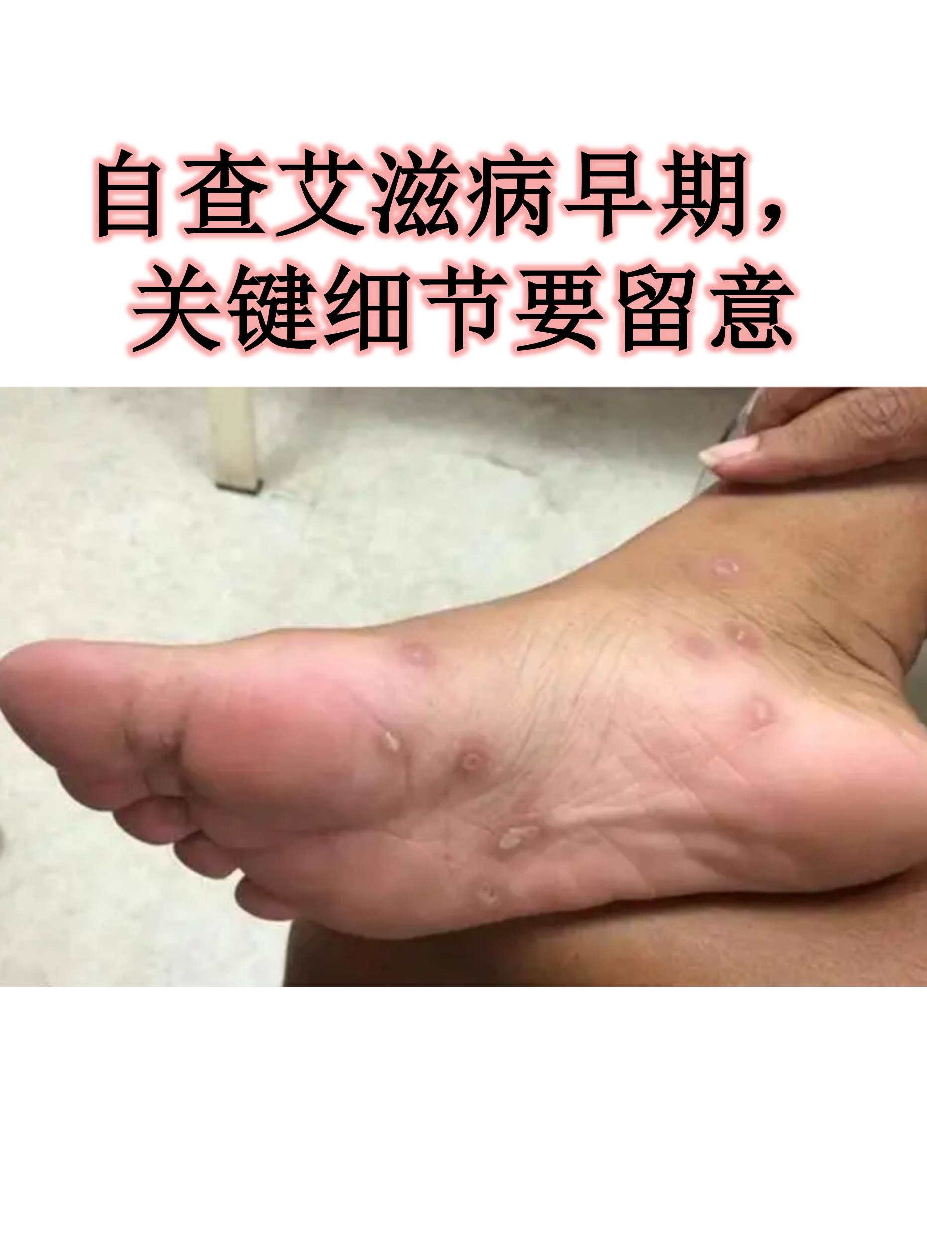 艾滋病有哪些症状