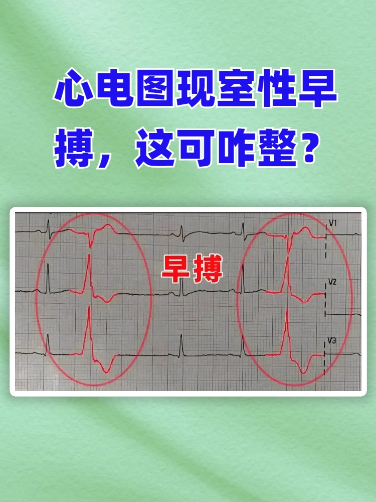 频发房性早搏是什么病