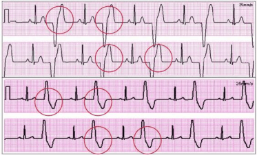 频发房性早搏是什么病