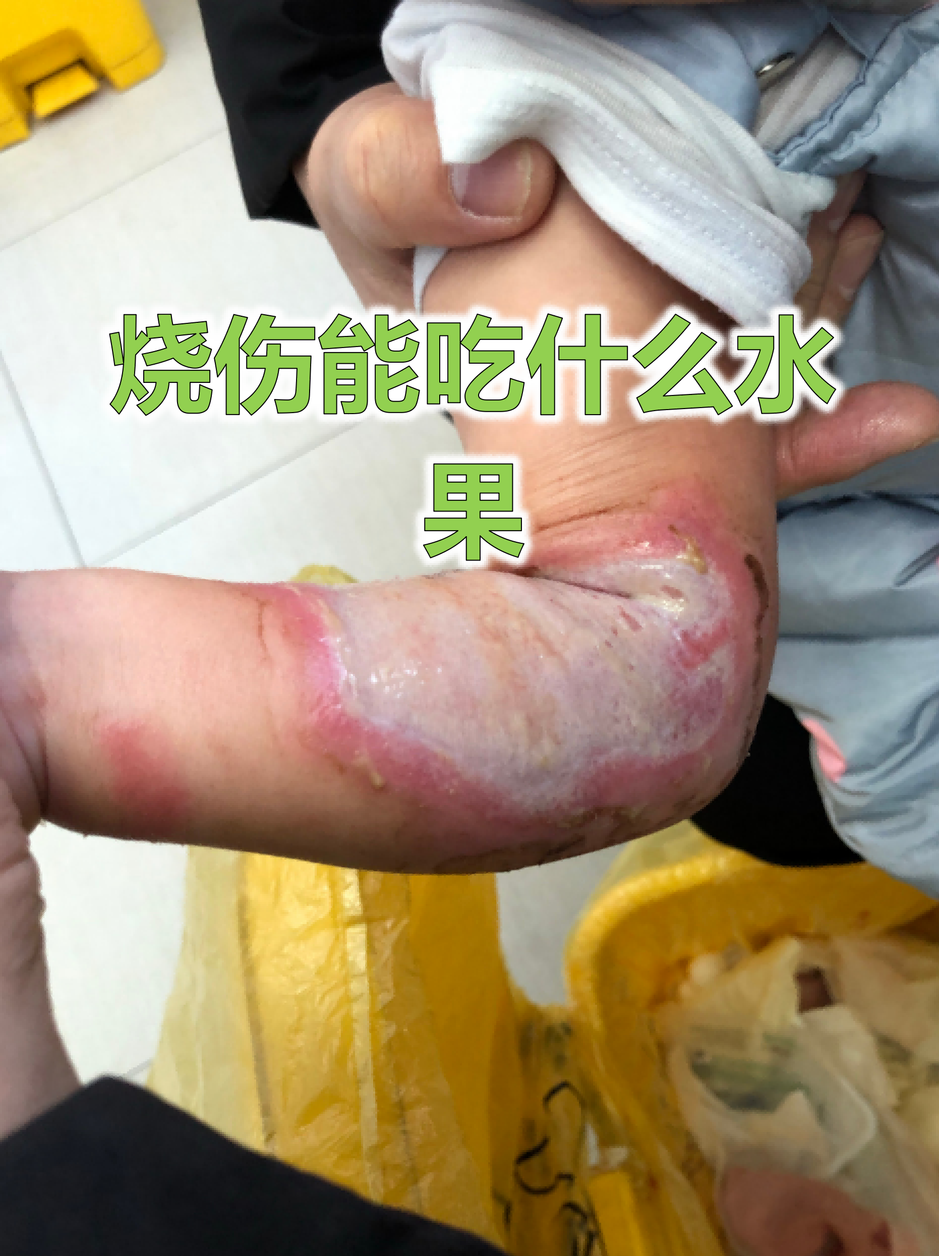 吃什么伤口愈合的快