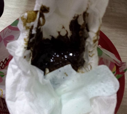 大便黑色不成形正常吗