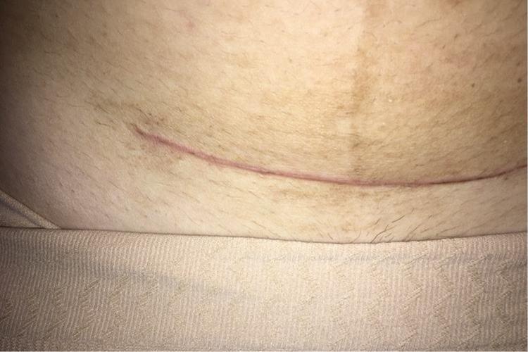 顺产侧切伤口多久恢复