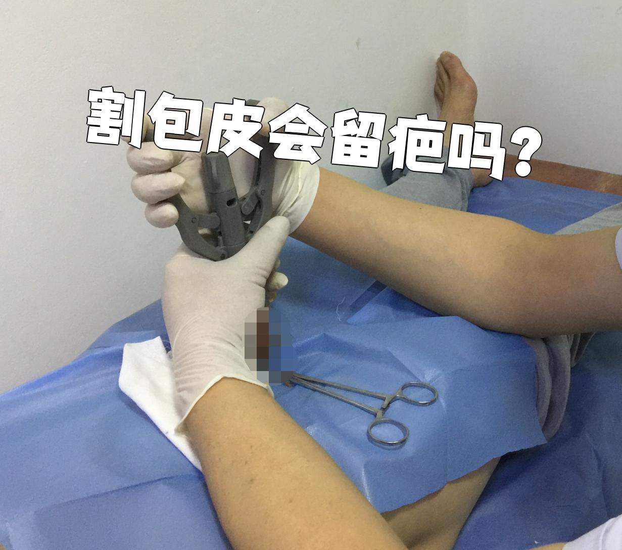 切包皮疼吗??????