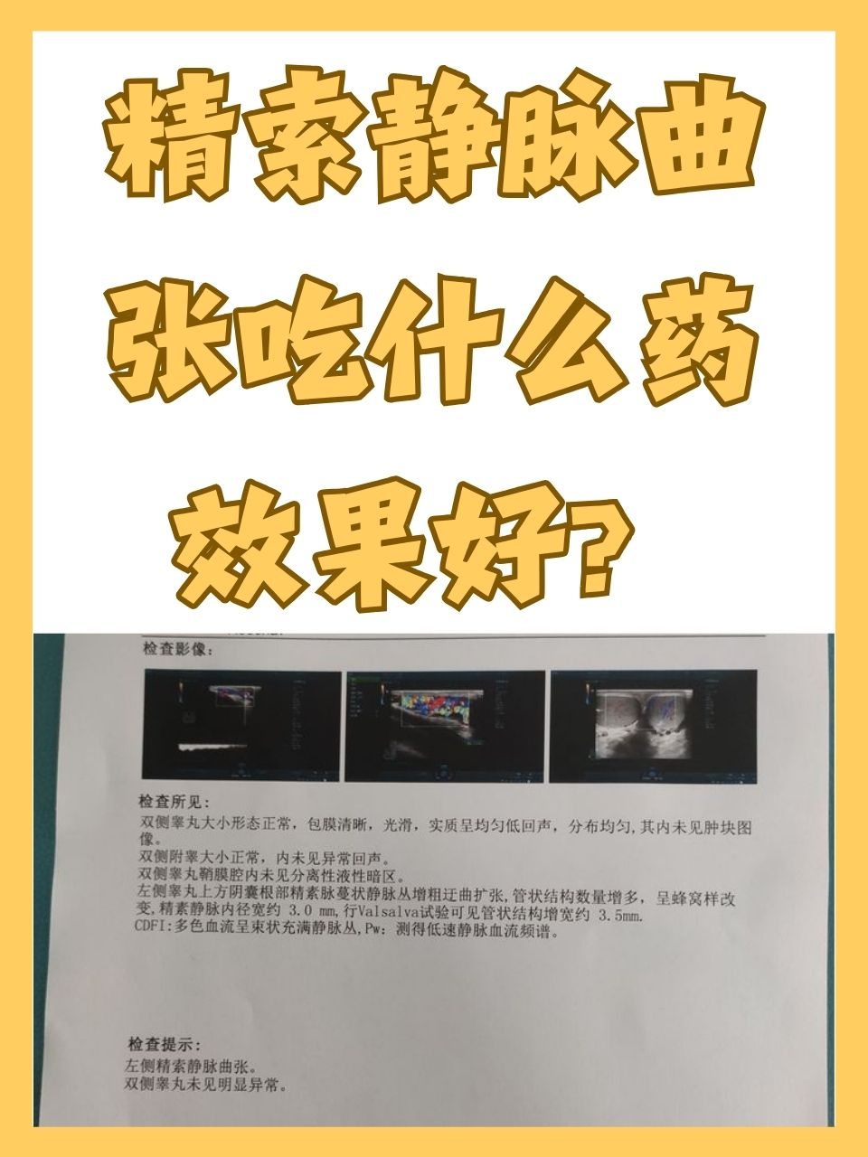 静脉曲张吃什么药最好