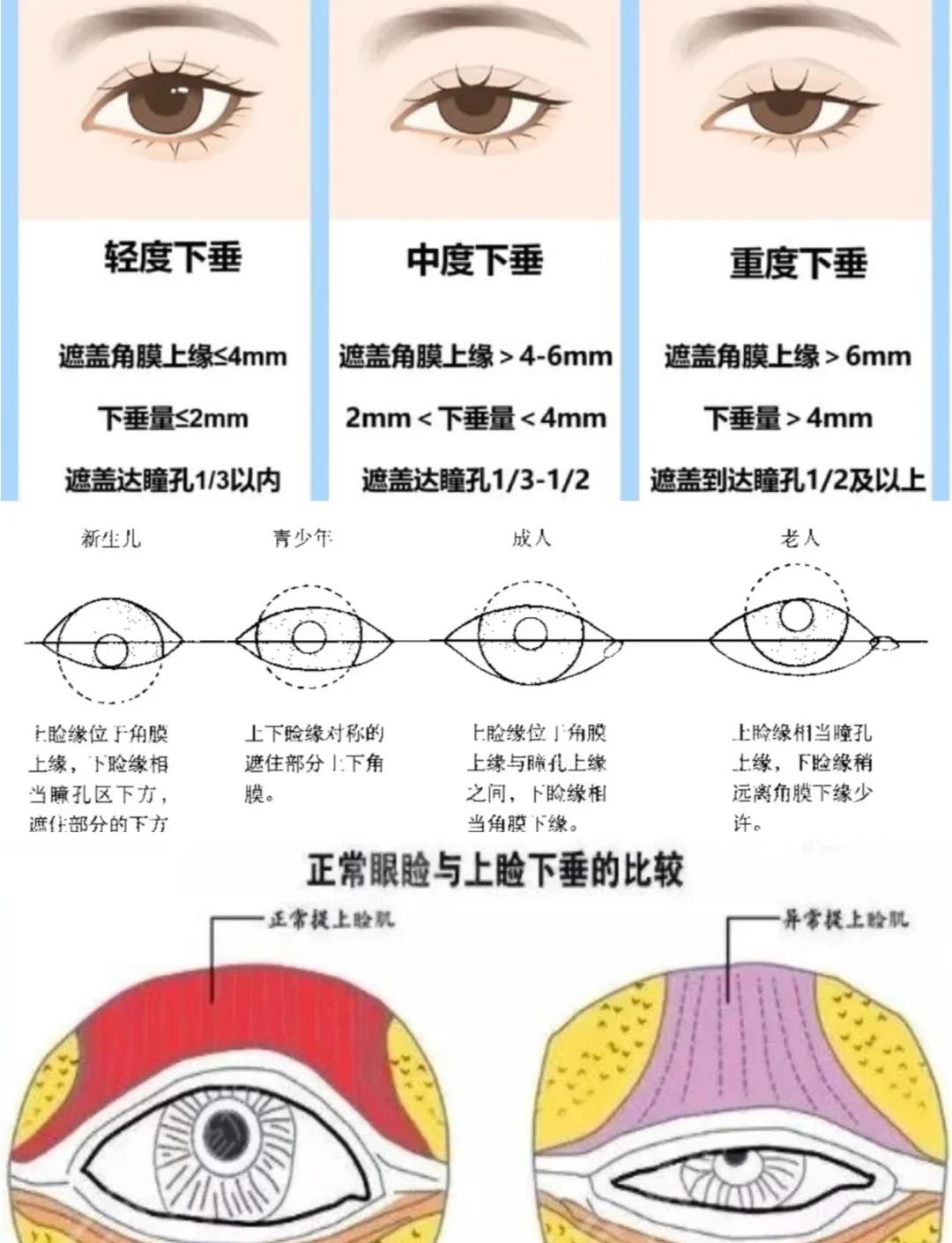 嘴角下垂如何改善