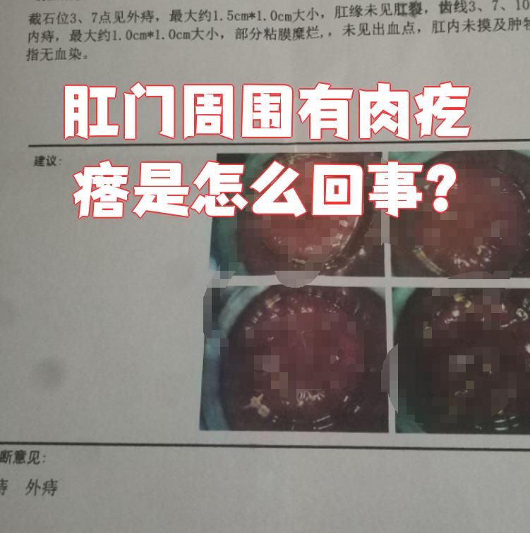 肛门边上长肉疙瘩是怎么回事?