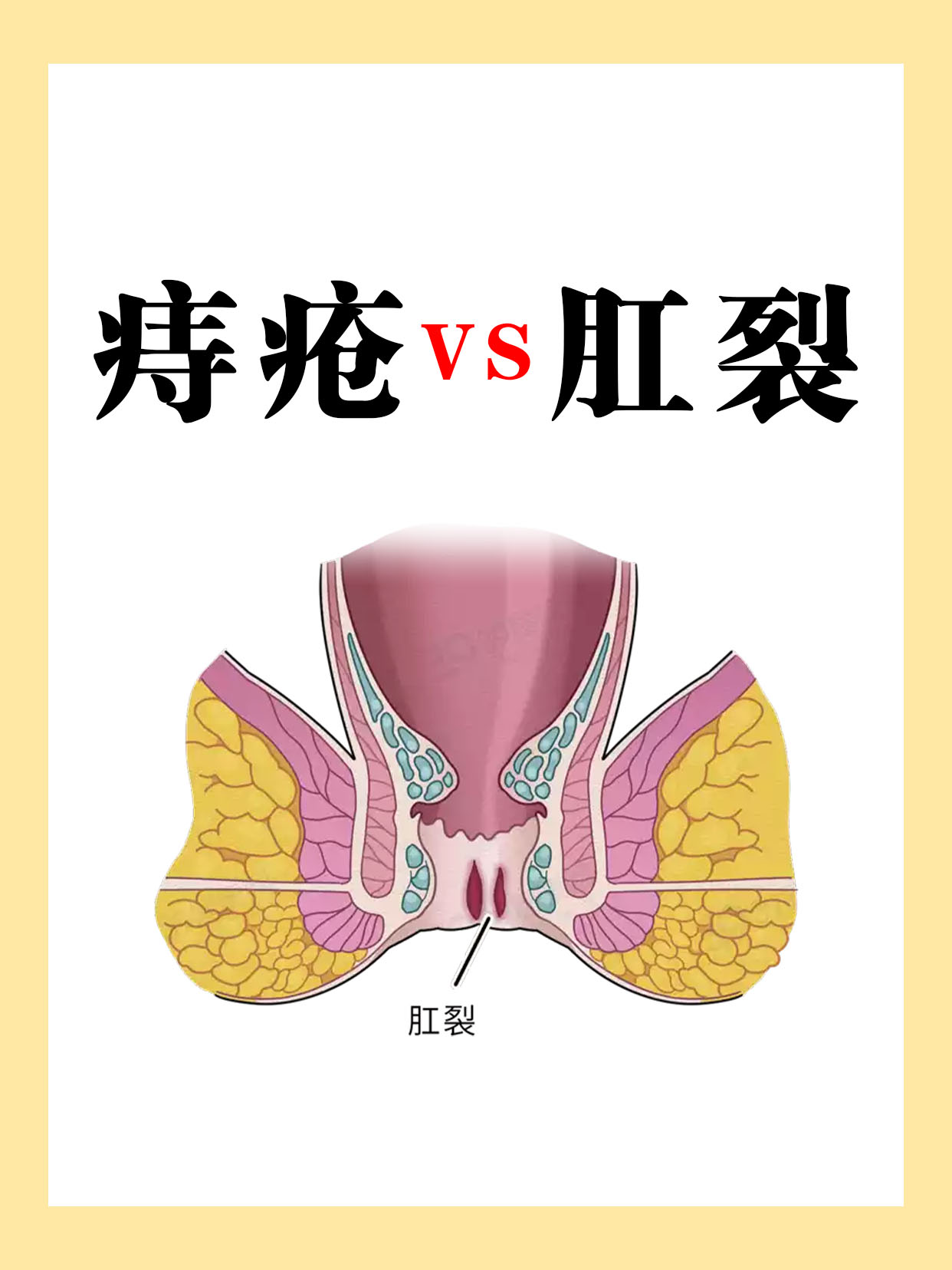 痔疮有遗传性吗