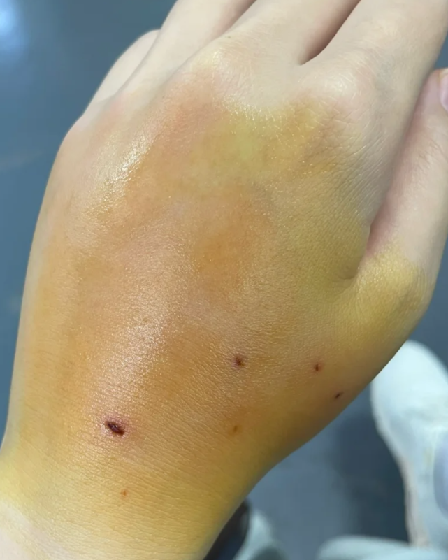 狂犬病发作有什么症状