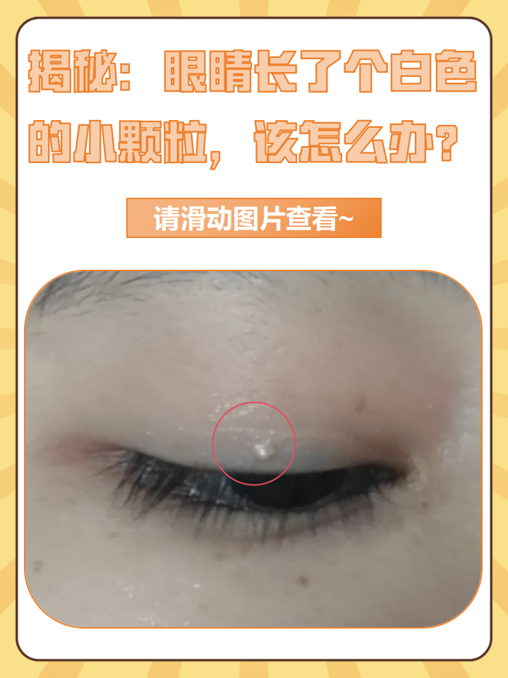 眼睛里面长了疙瘩,是怎么回事