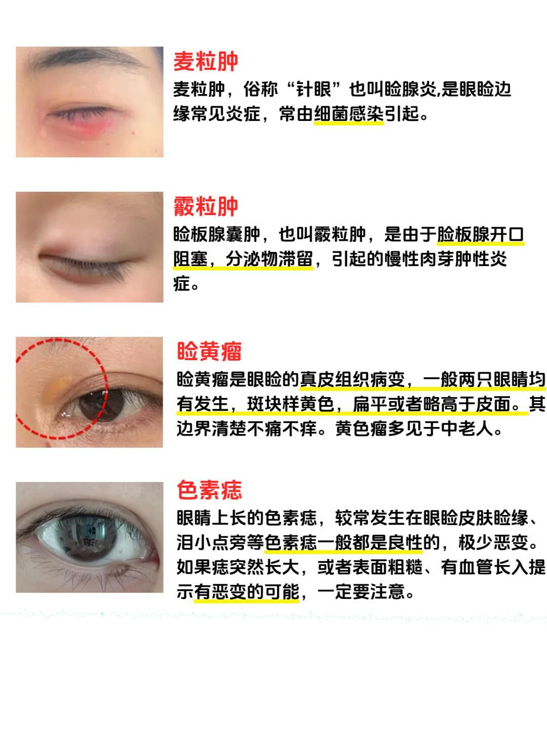 眼睛里面长了疙瘩,是怎么回事