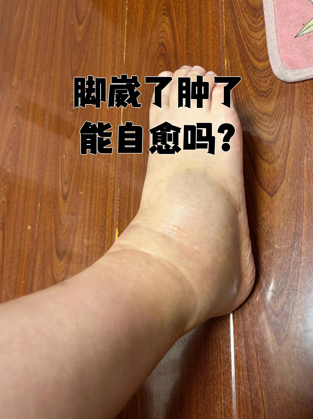 脚扭伤肿了怎么样才能好得快