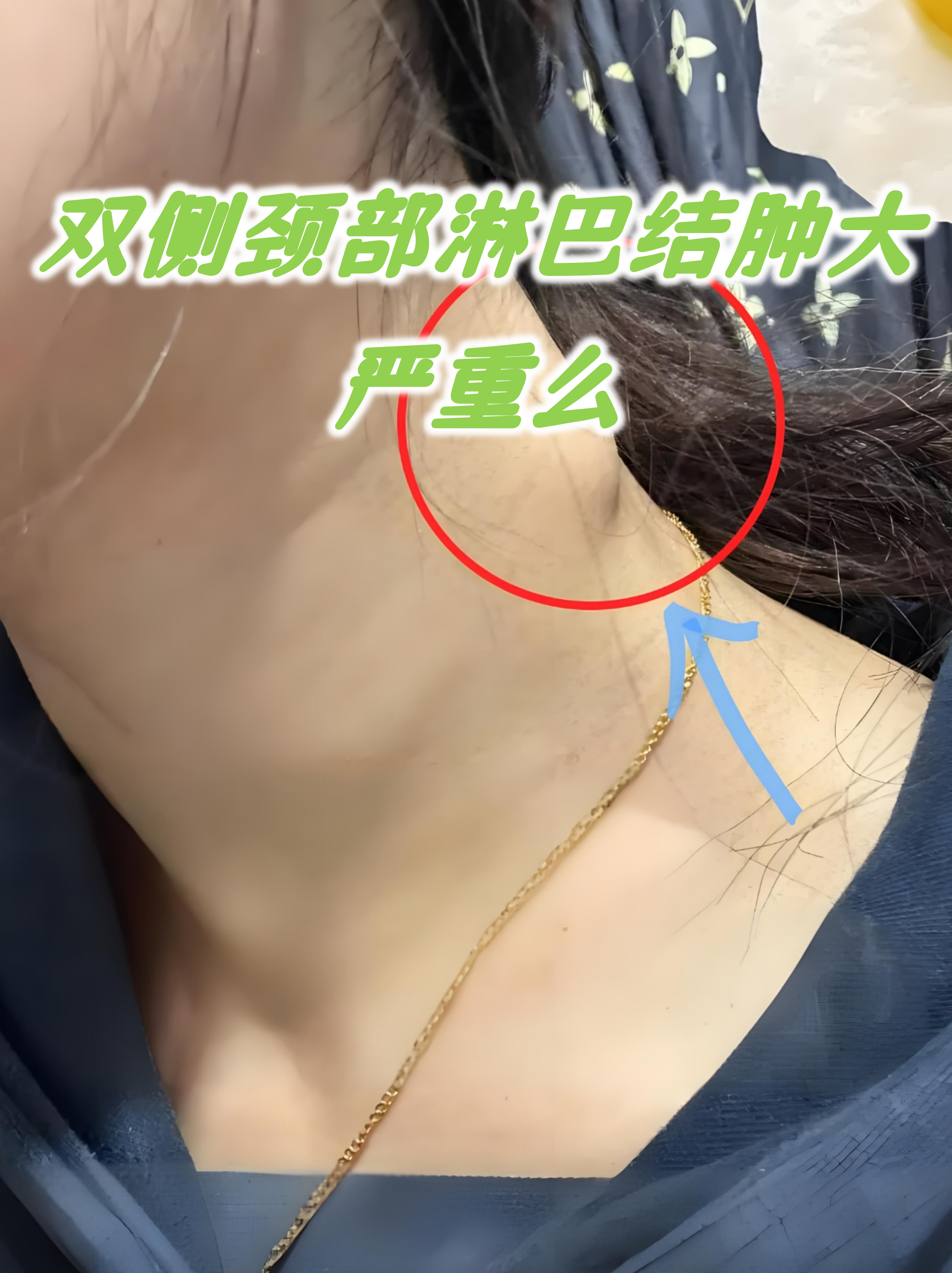 颈部淋巴发炎大概需要多久能好