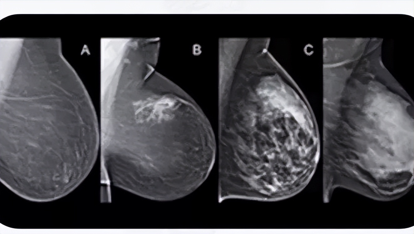 乳腺钼靶和彩超的区别
