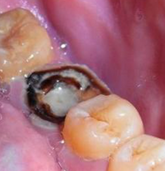 牙髓炎的症状有哪些?