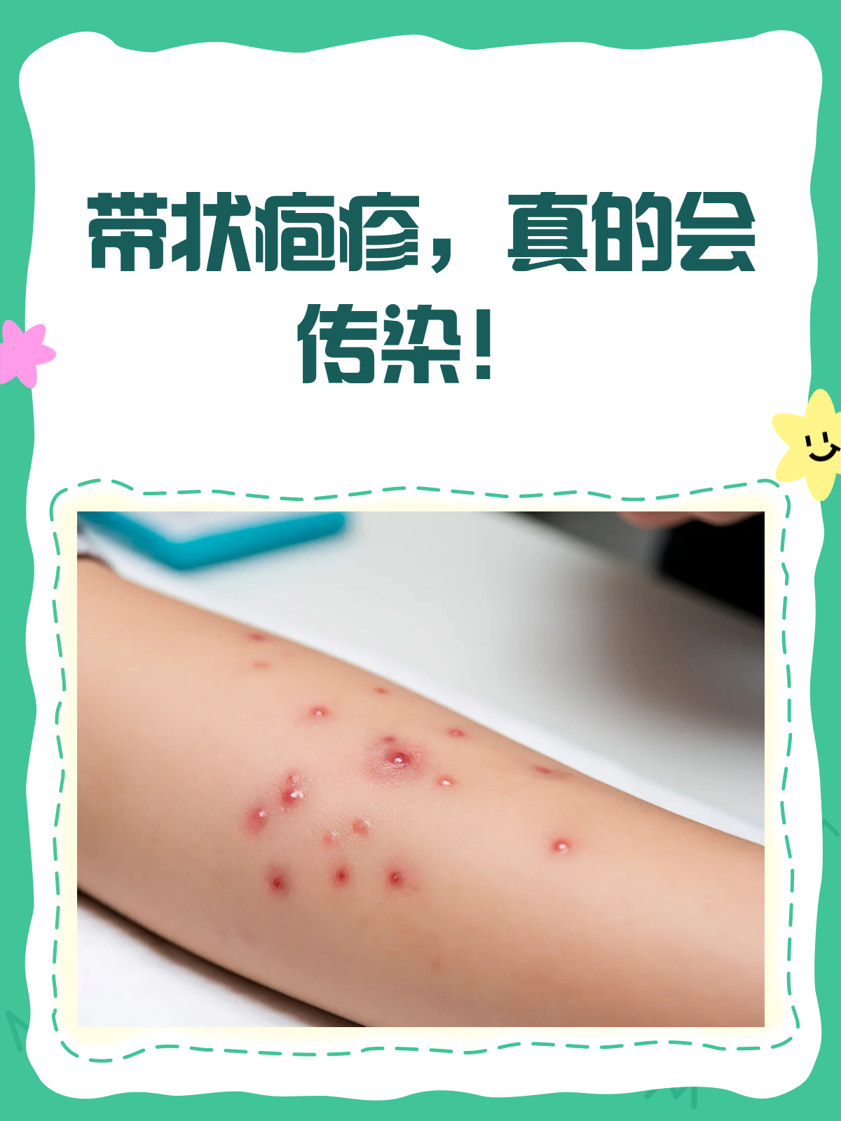 带状疱疹接触会传染吗