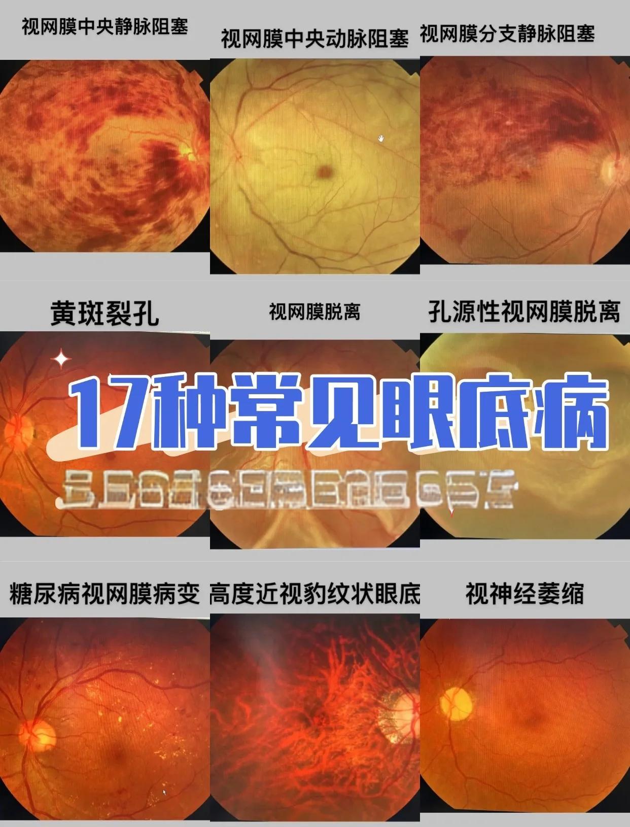 黄斑裂孔的原因有哪些?