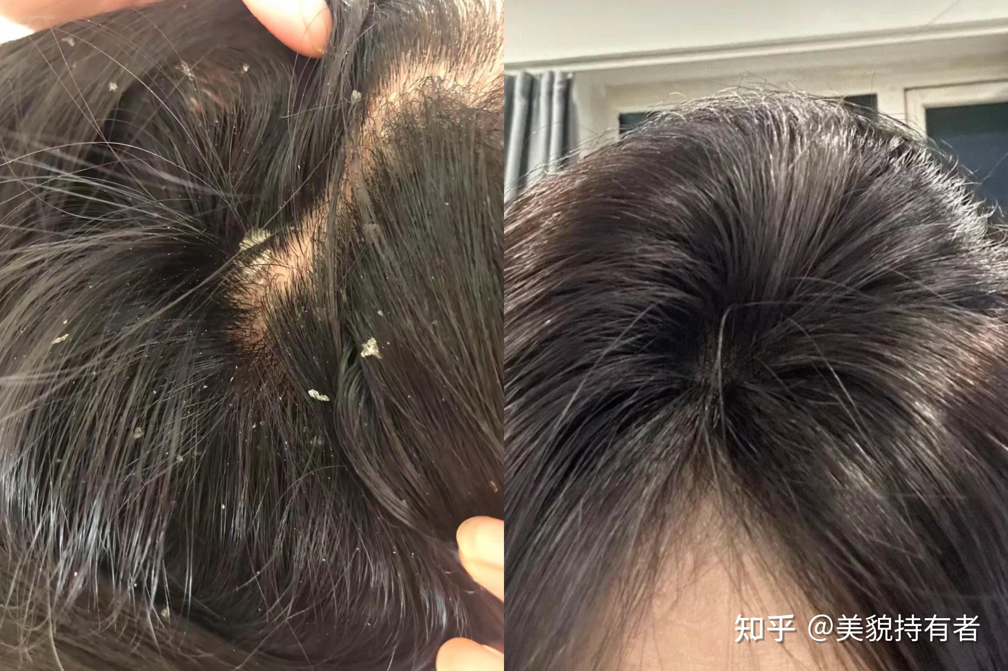 长期长头皮屑是什么原因