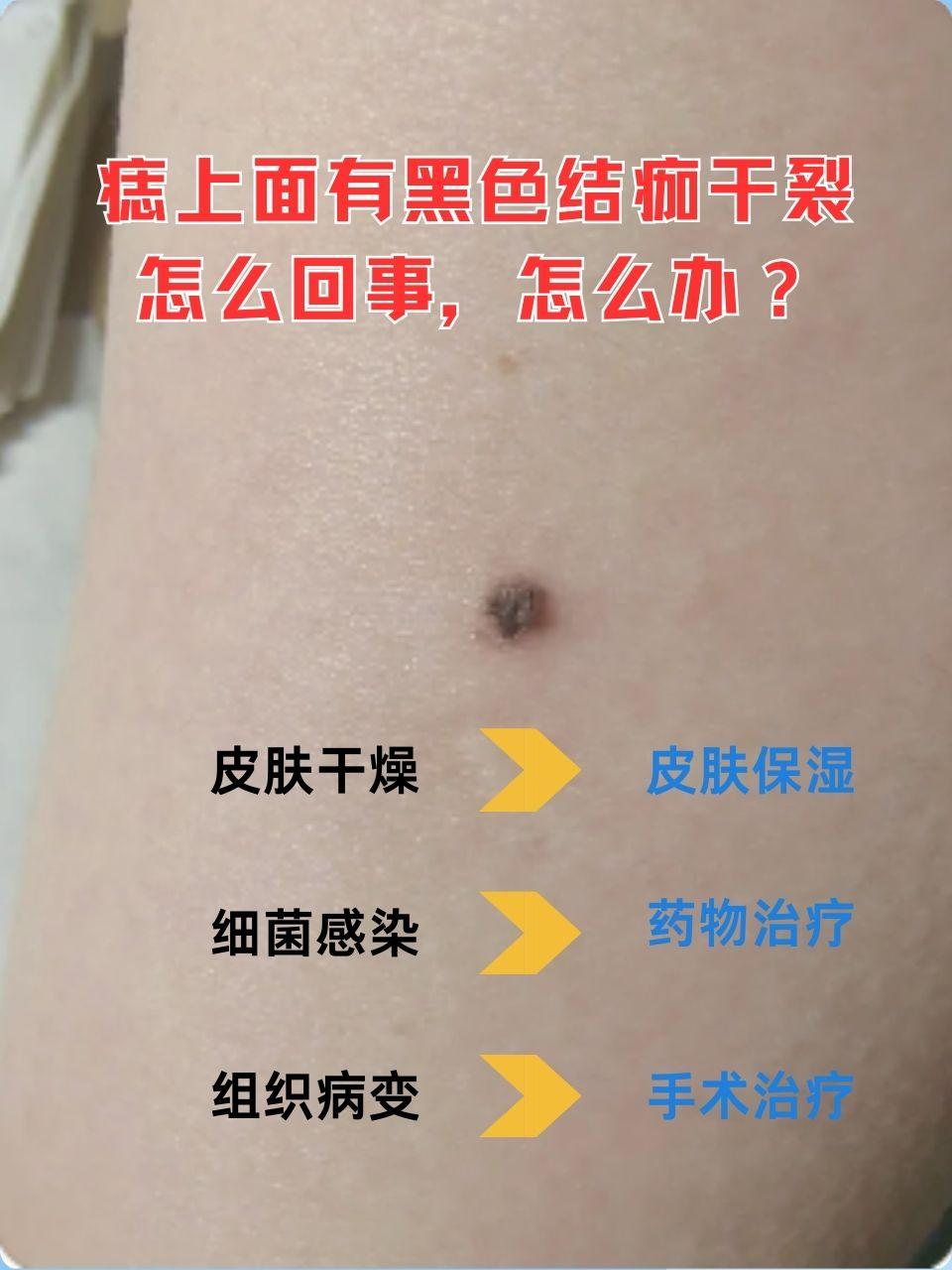 皮脂腺痣什么意思
