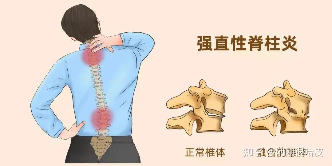 什么是强直性脊柱炎?