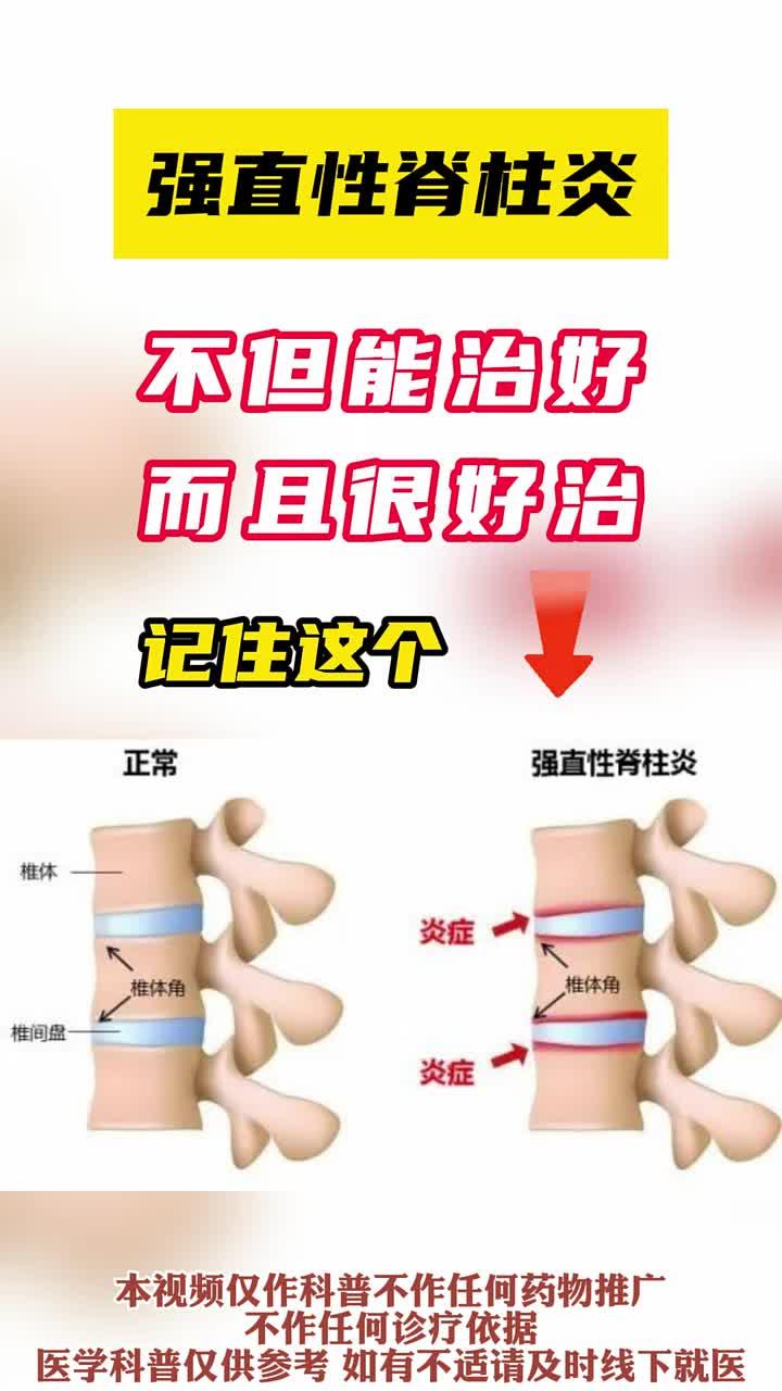 什么是强直性脊柱炎?