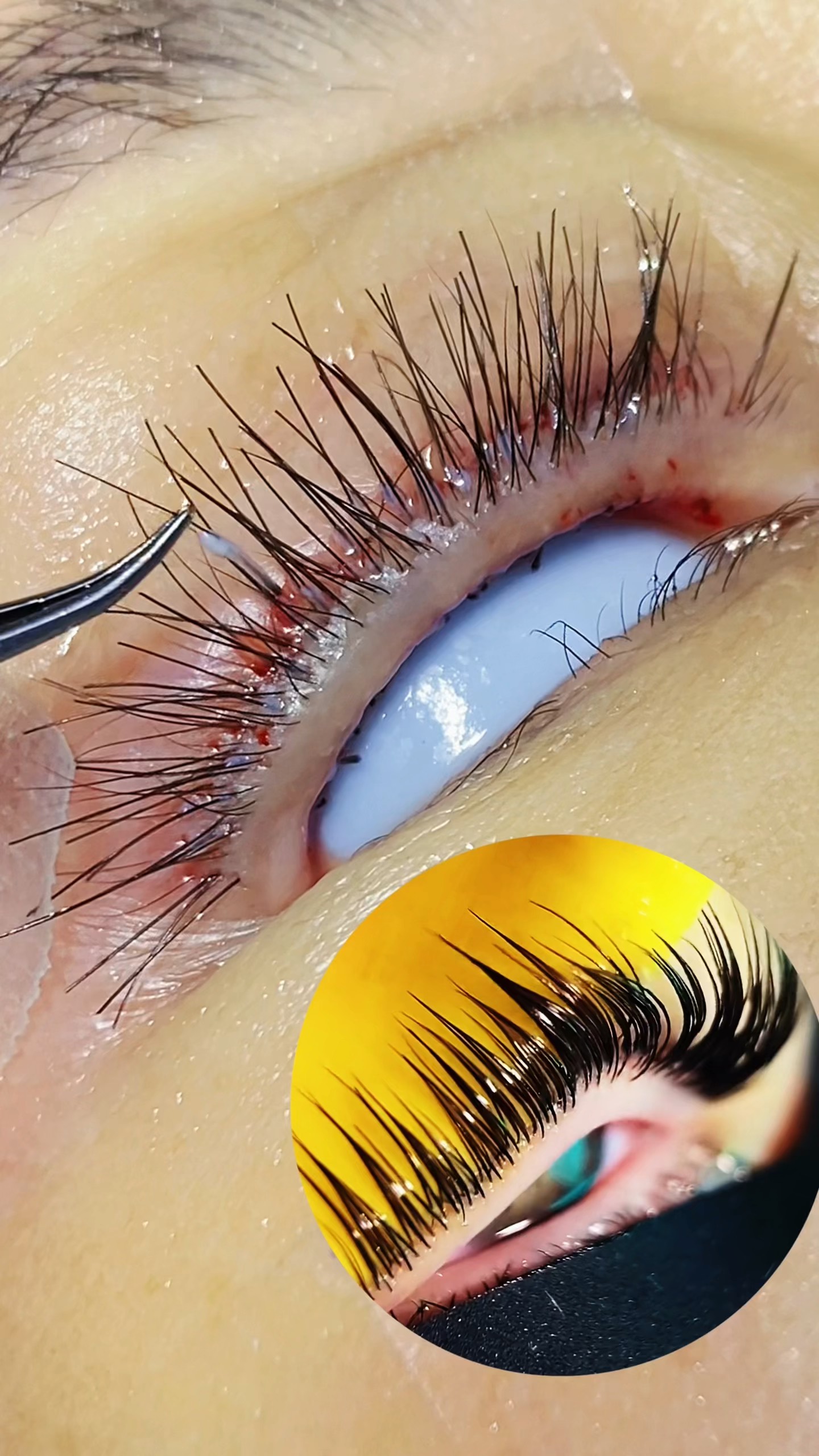 什么是种植眉毛.