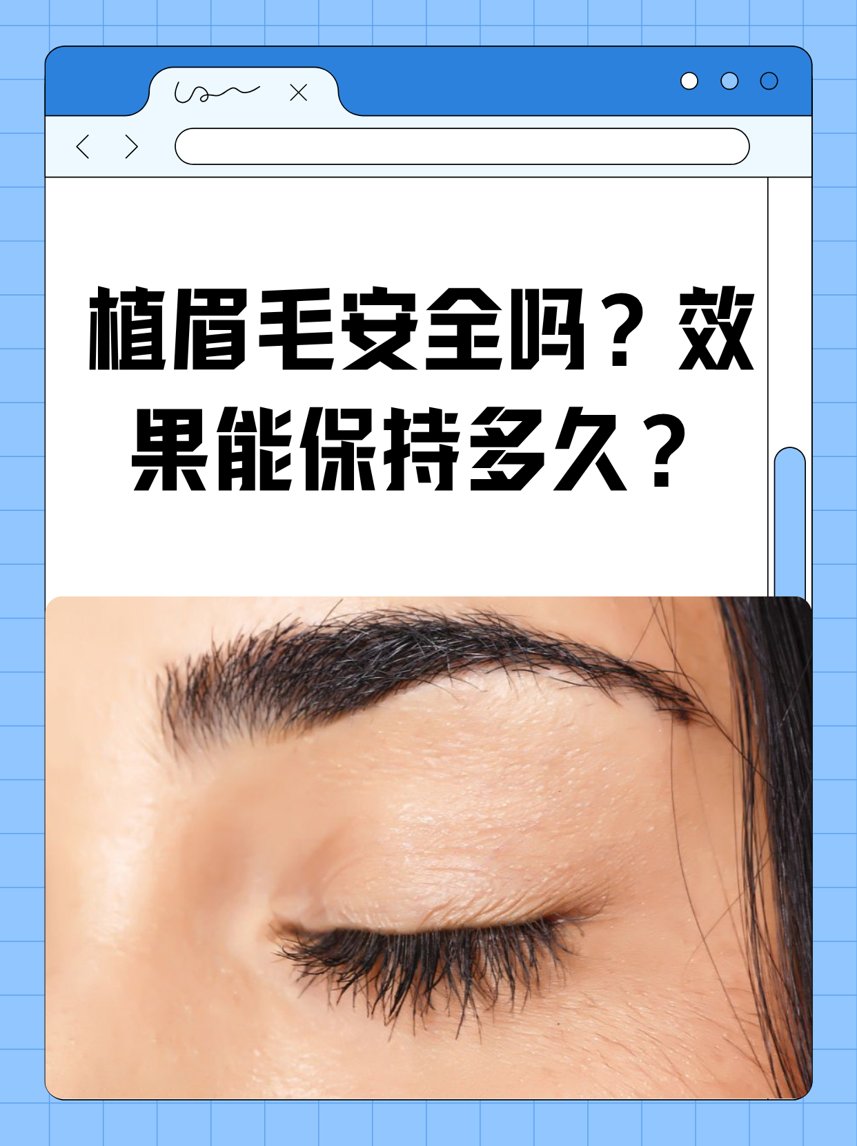 什么是种植眉毛.