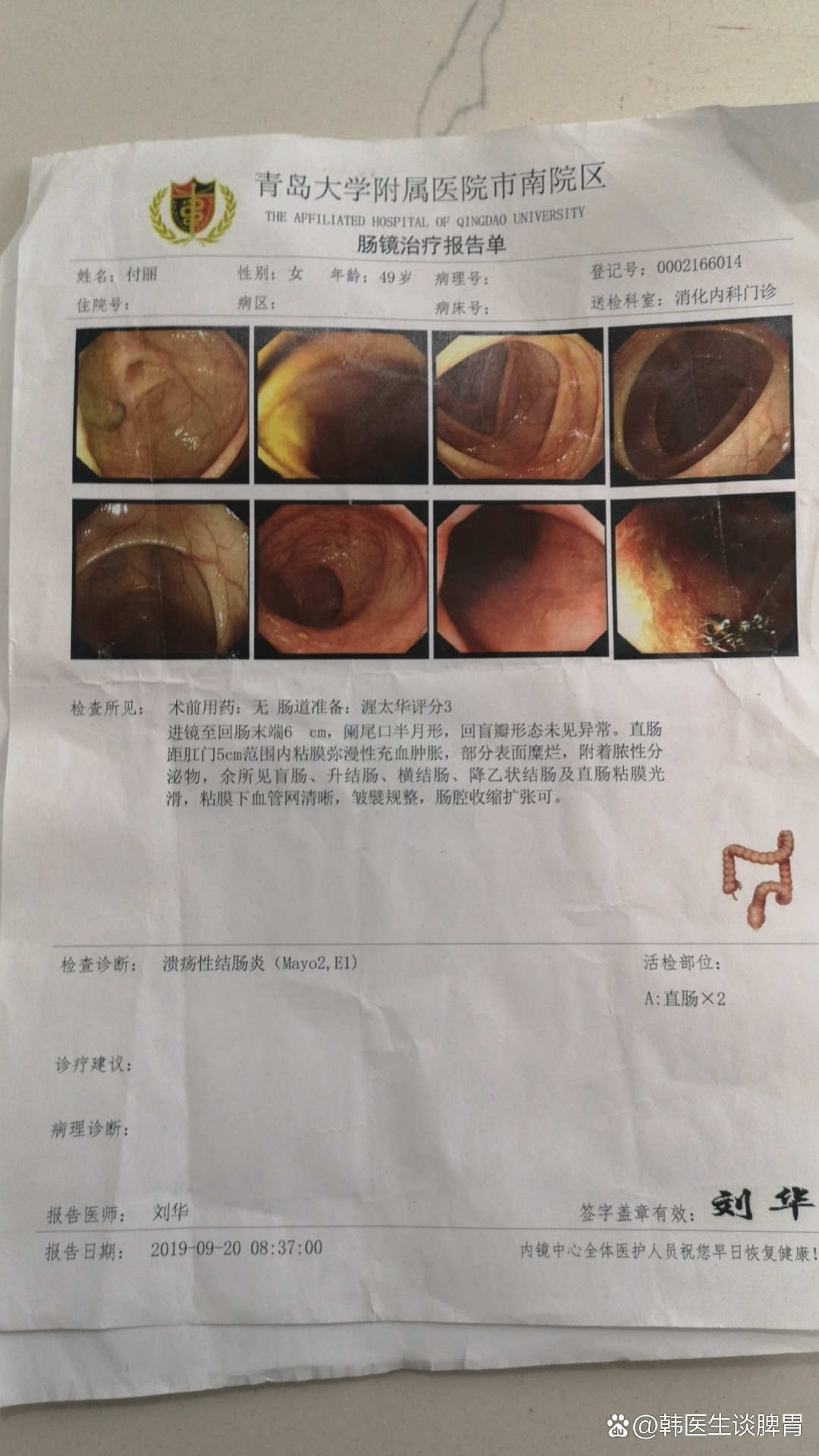 溃疡性结肠炎伴中毒性巨结肠