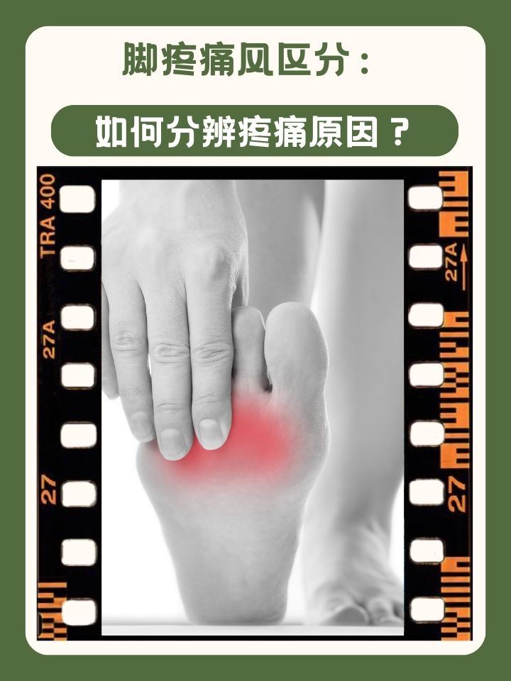 痛风脚肿怎么消肿止痛?