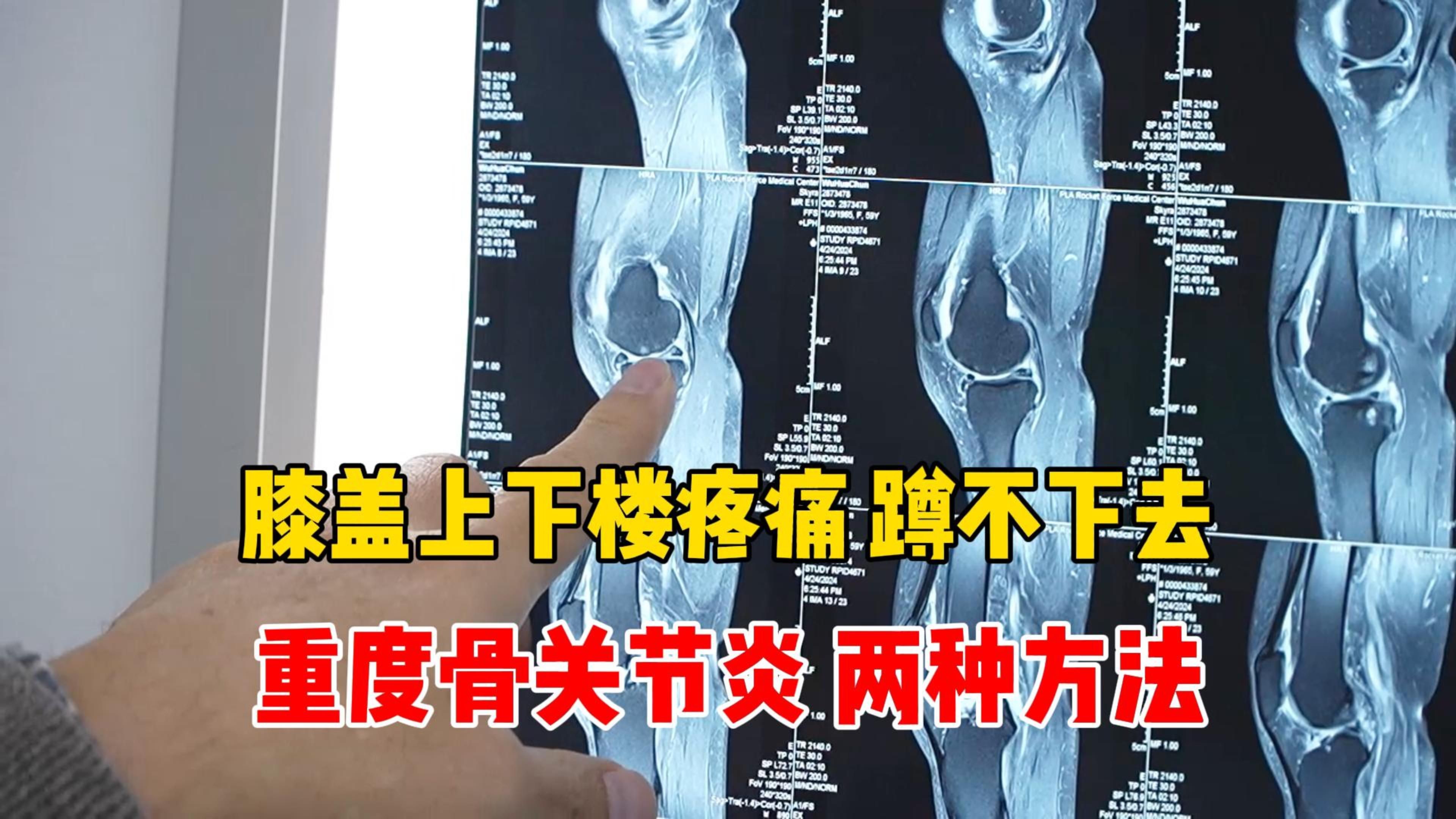 软骨炎是什么病