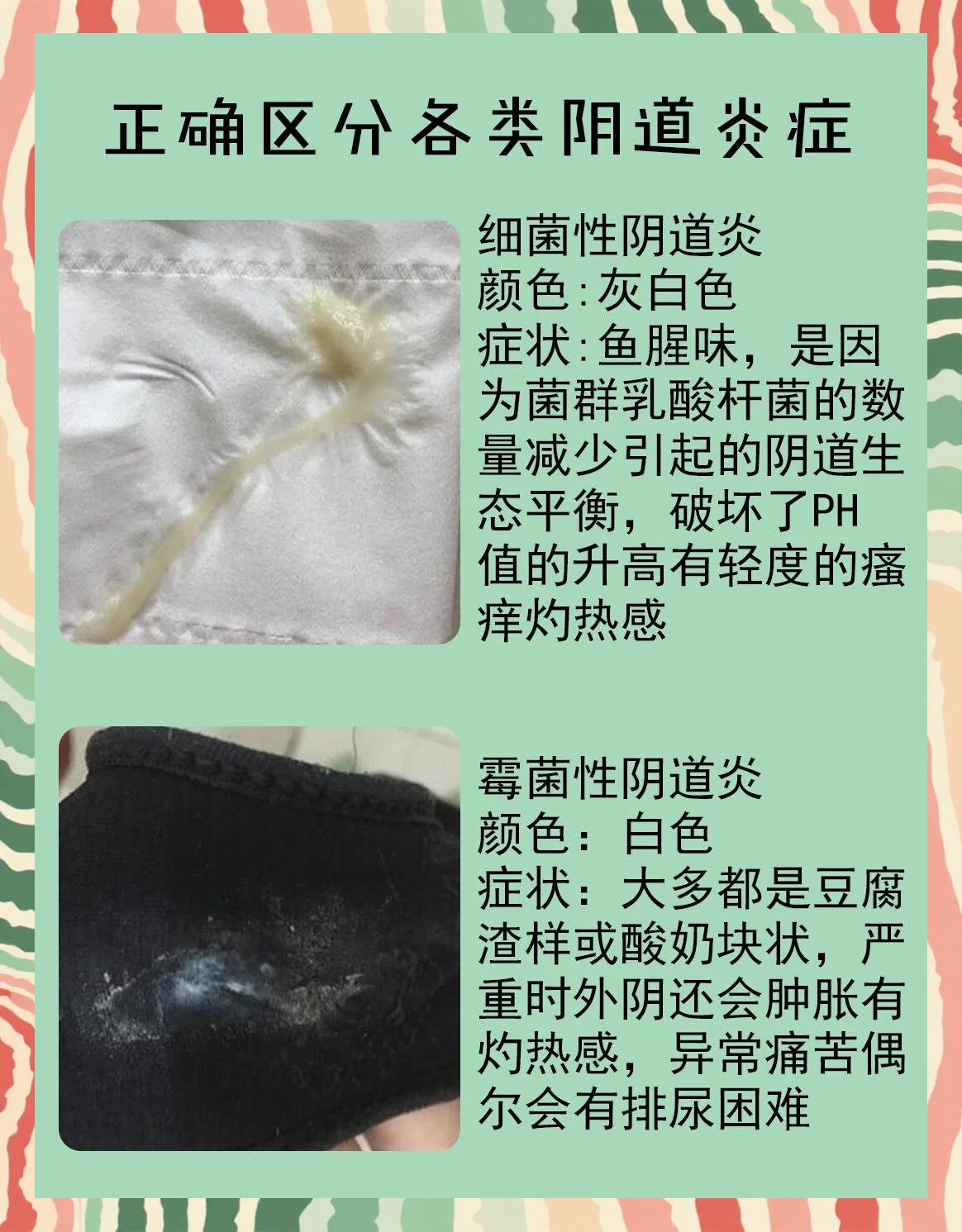 白带多,不来月经怎么回事