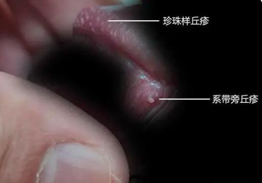 龟头冠状沟长了一圈白色颗粒东西是什么..