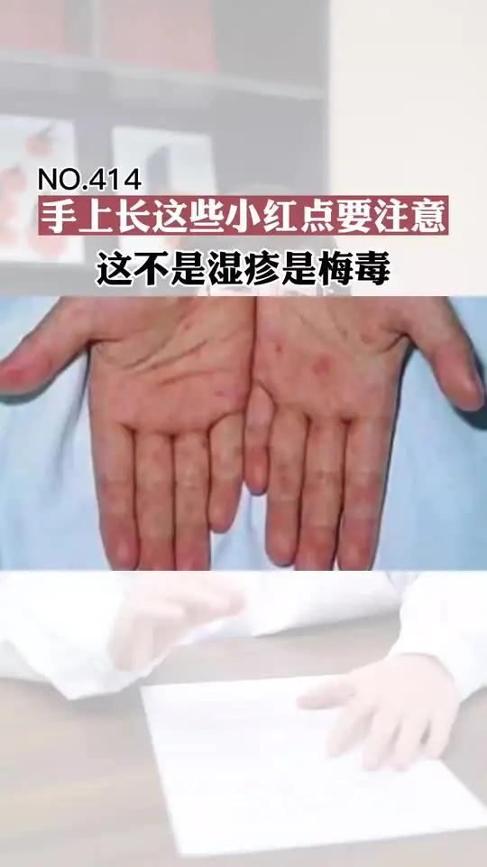请问手掌红点是什么有点刺痛有点痒