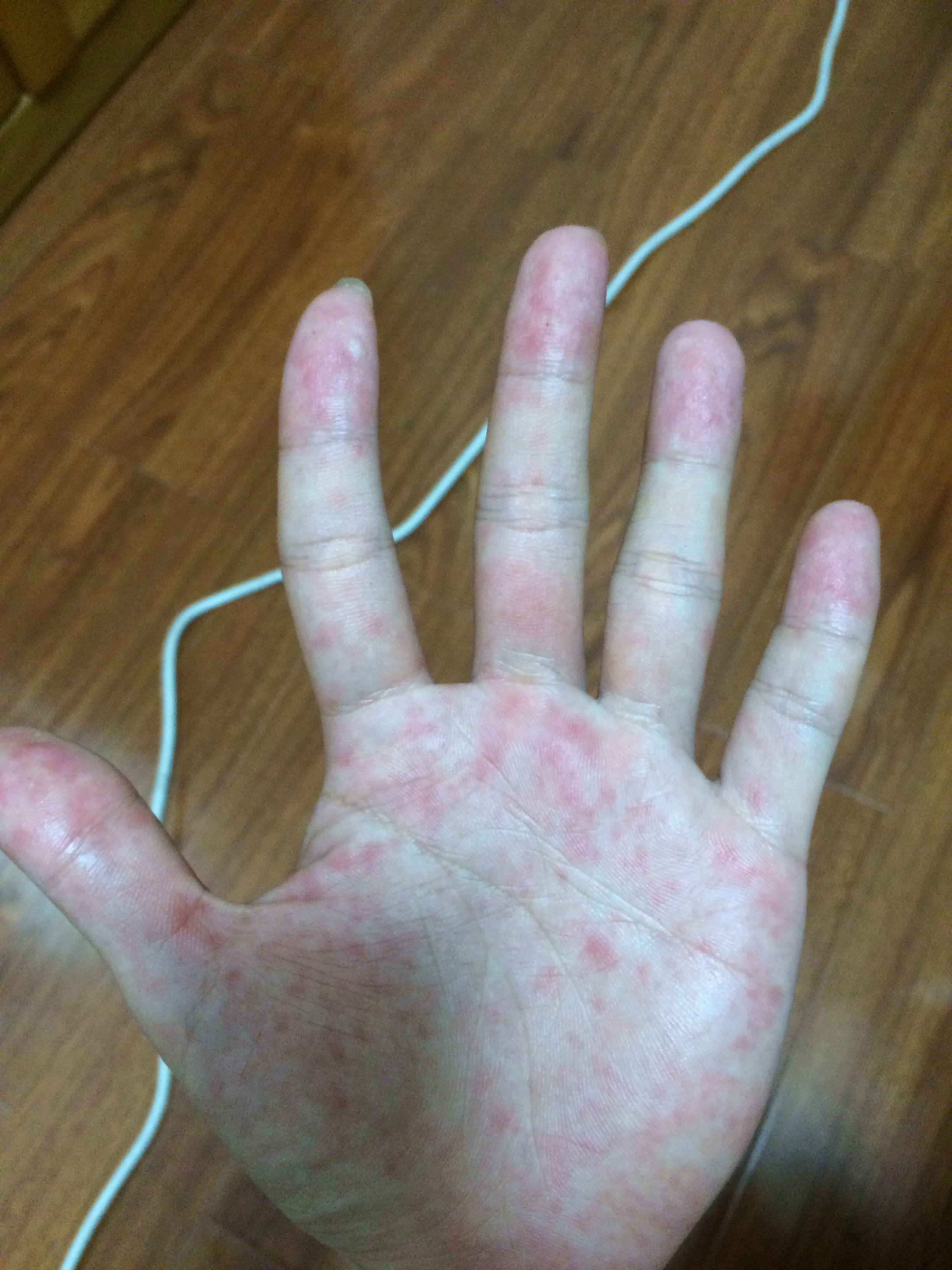 请问手掌红点是什么有点刺痛有点痒