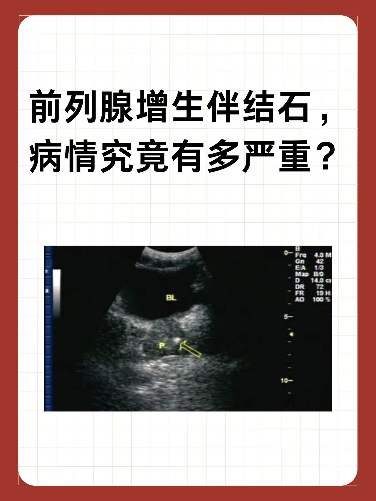 彩超能检查出前列腺炎吗?