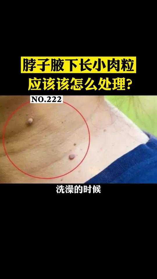 纤维瘤会不会癌变?