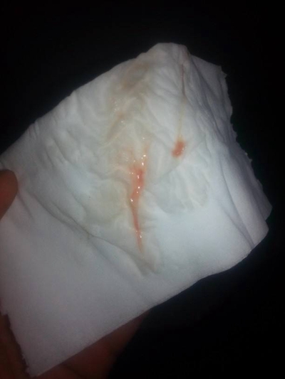 白带有血是怎么回事??????