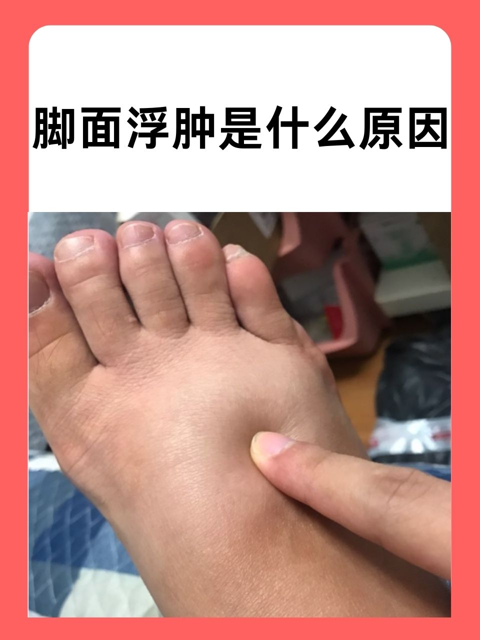 全身浮肿什么原因