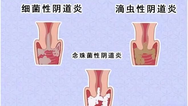 为什么来大姨妈前会有褐色分泌物