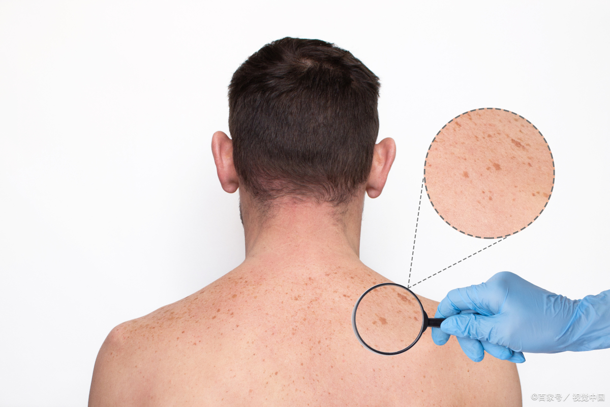 毛周角化病能根治吗?