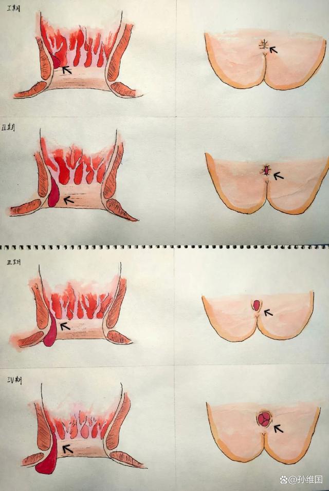 痔疮长在什么地方..