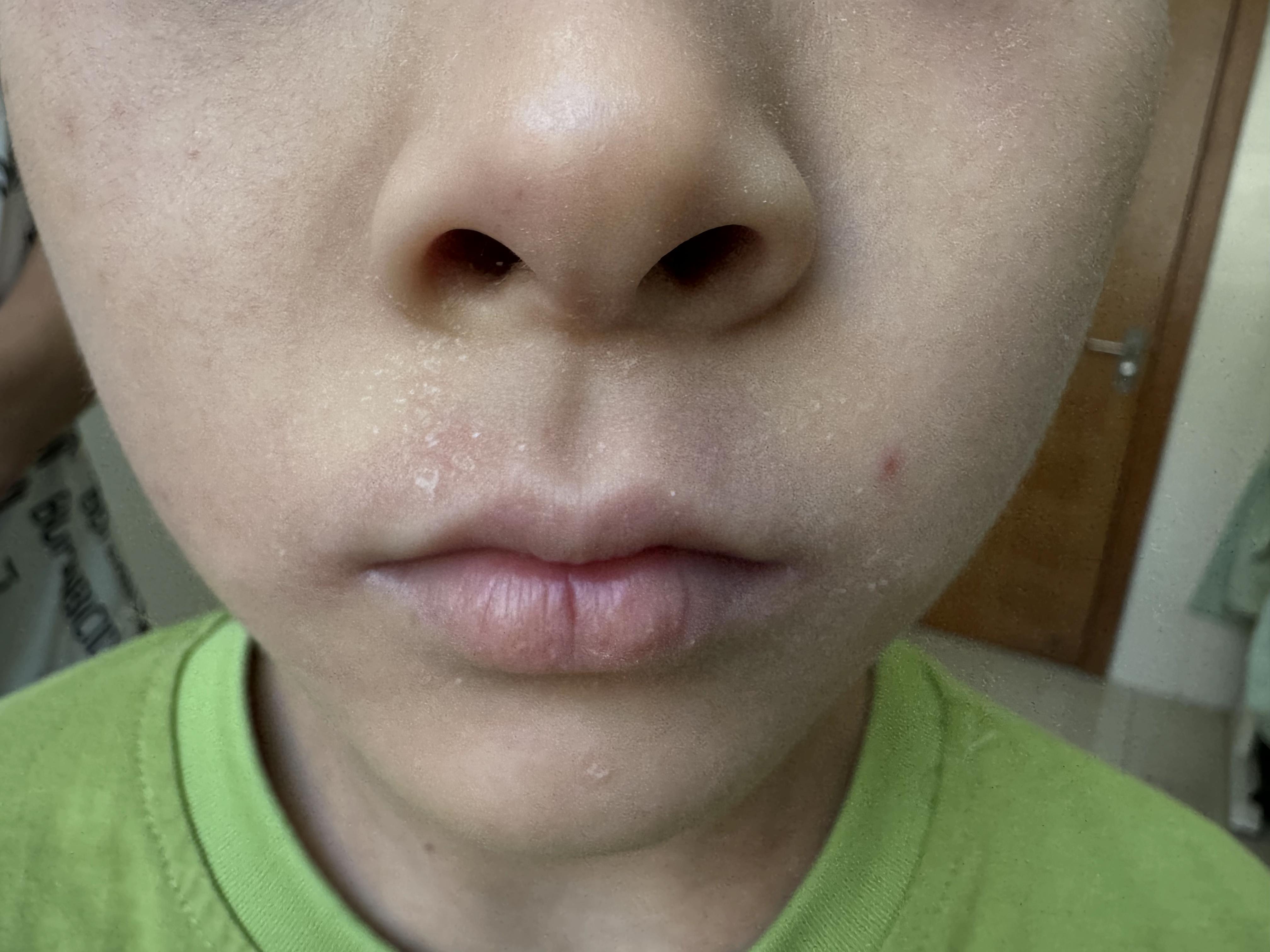 宝宝脸上长湿疹怎么办