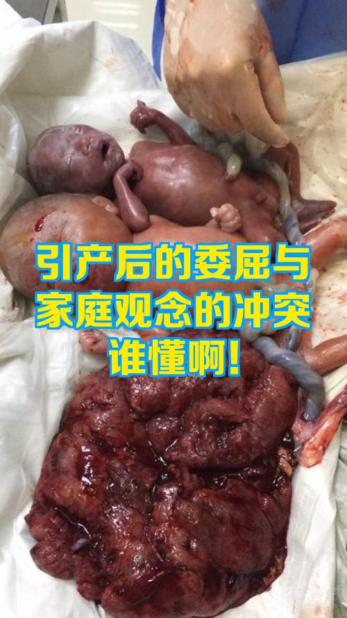 引产后可以直接出院吗