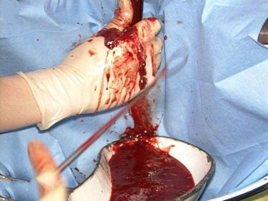 无痛人工流产术