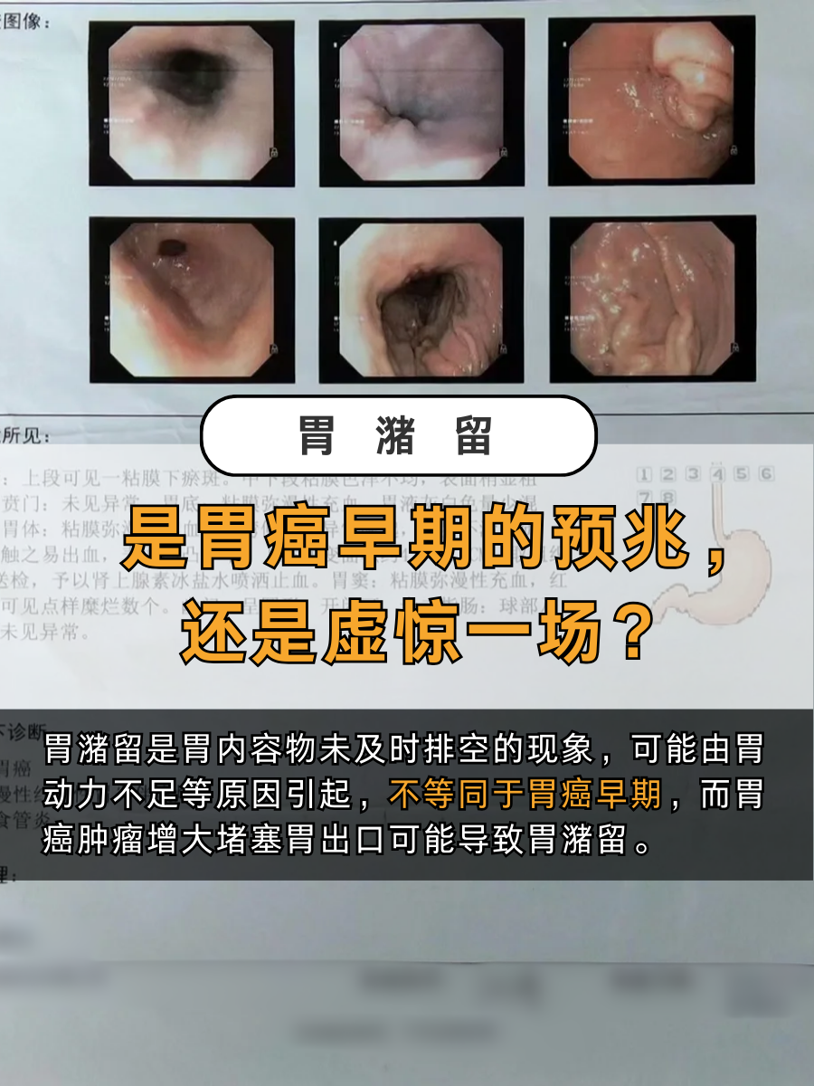 经常嗳气是胃癌前兆吗