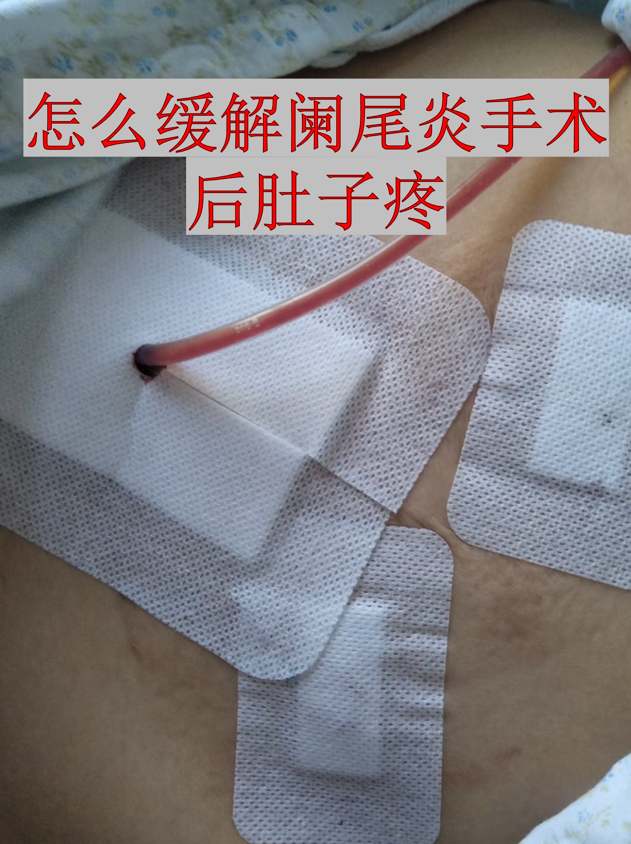 阑尾炎手术后多久完全恢复