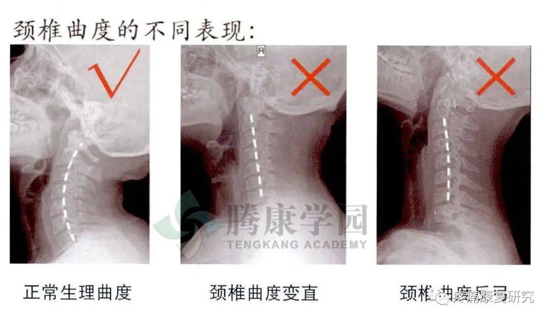 颈椎反弓,能治好吗?