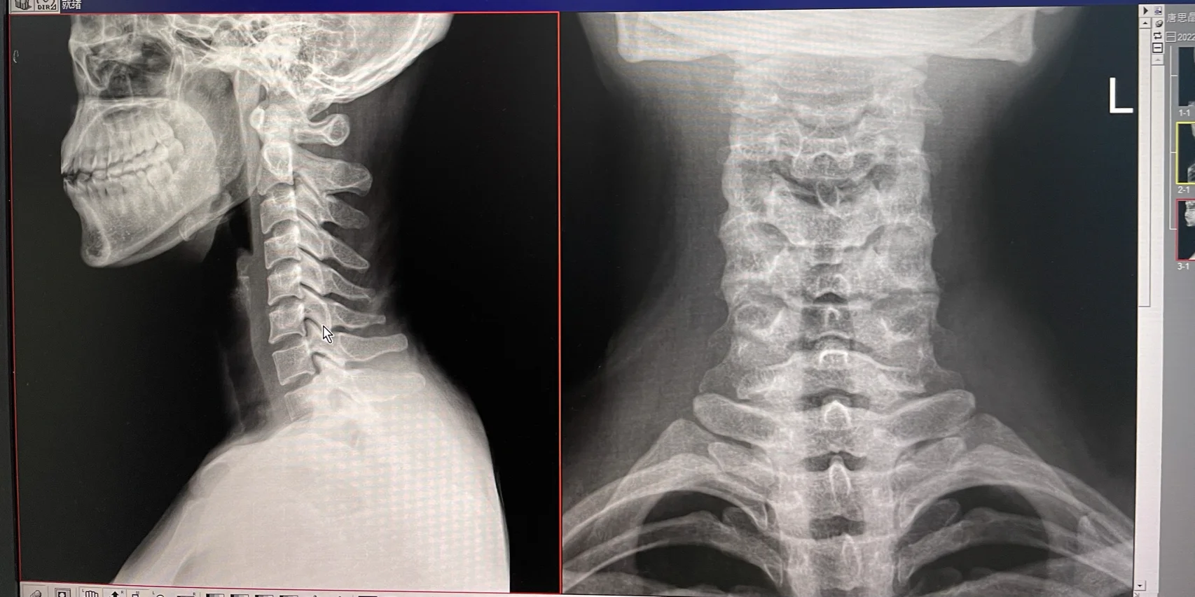 颈椎反弓,能治好吗?