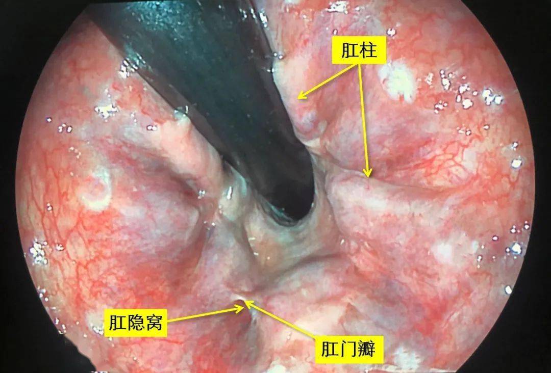 怎么判断自己有没有得肛瘘