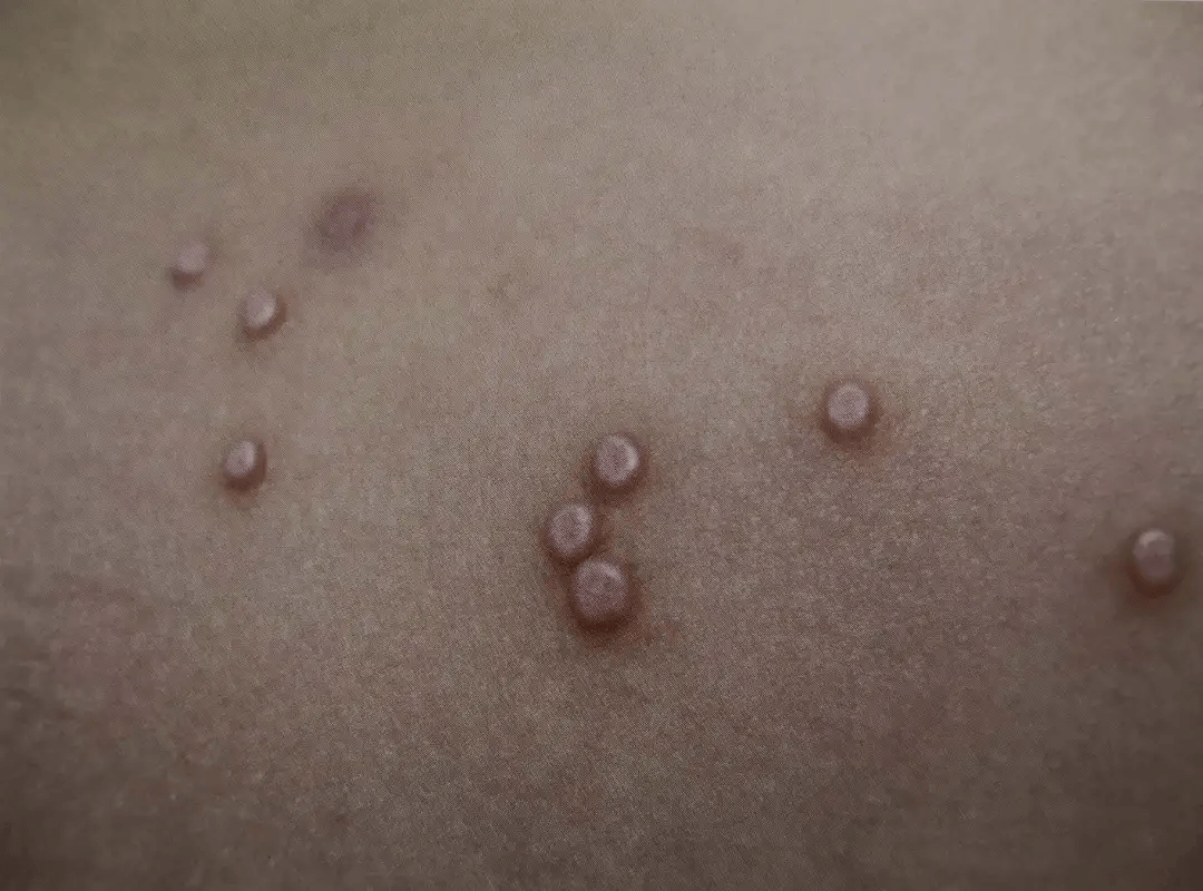 身体长疙瘩是什么情况