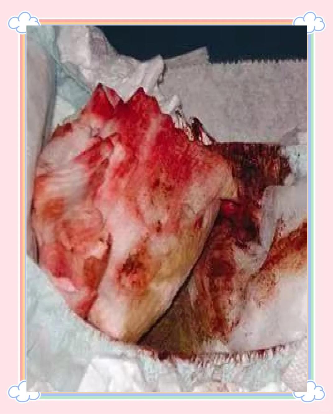 便血鲜红色是癌症吗?